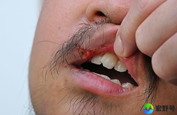 Ferdianto Suwandi show stitches on his upper lip.