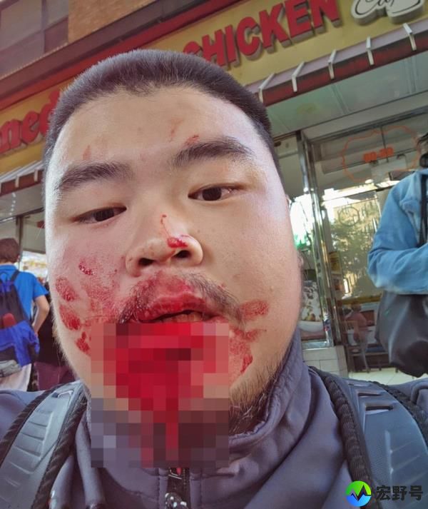 Ferdianto Suwandi shows his bloody lip after sucker-punch attack.